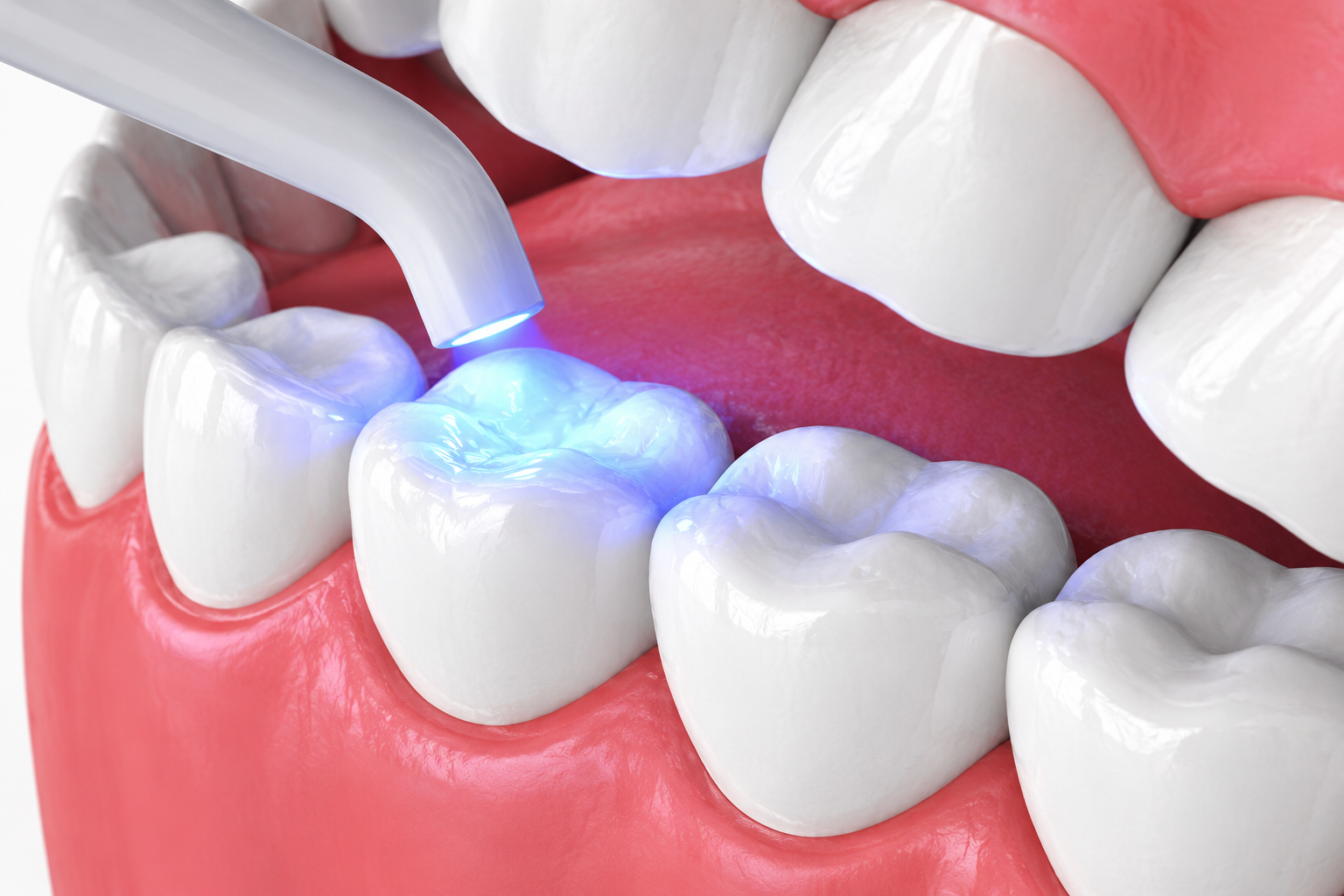 trám răng thẩm mỹ - hình 4