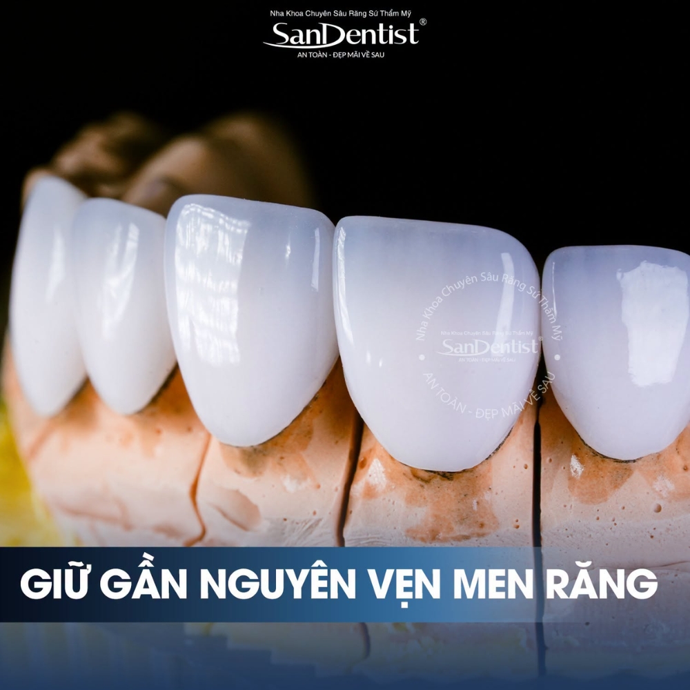 veneer emax vs lisi - hình 3