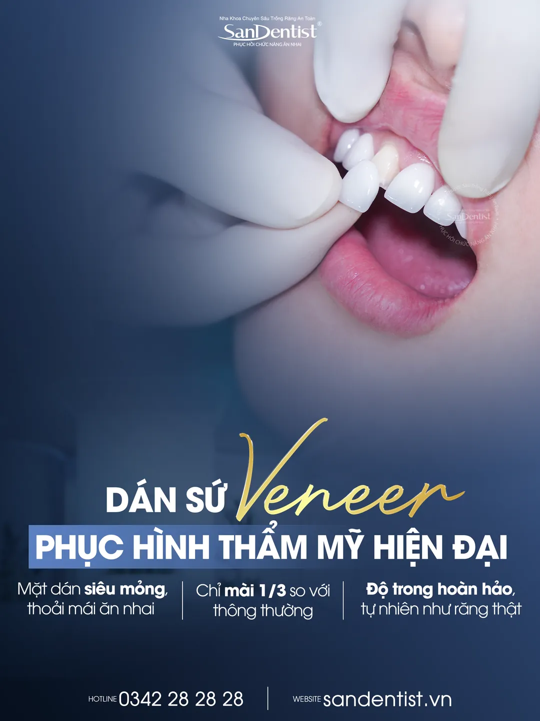 Dán sứ Veneer phục hình thẩm mỹ hiện đại tại San Dentist