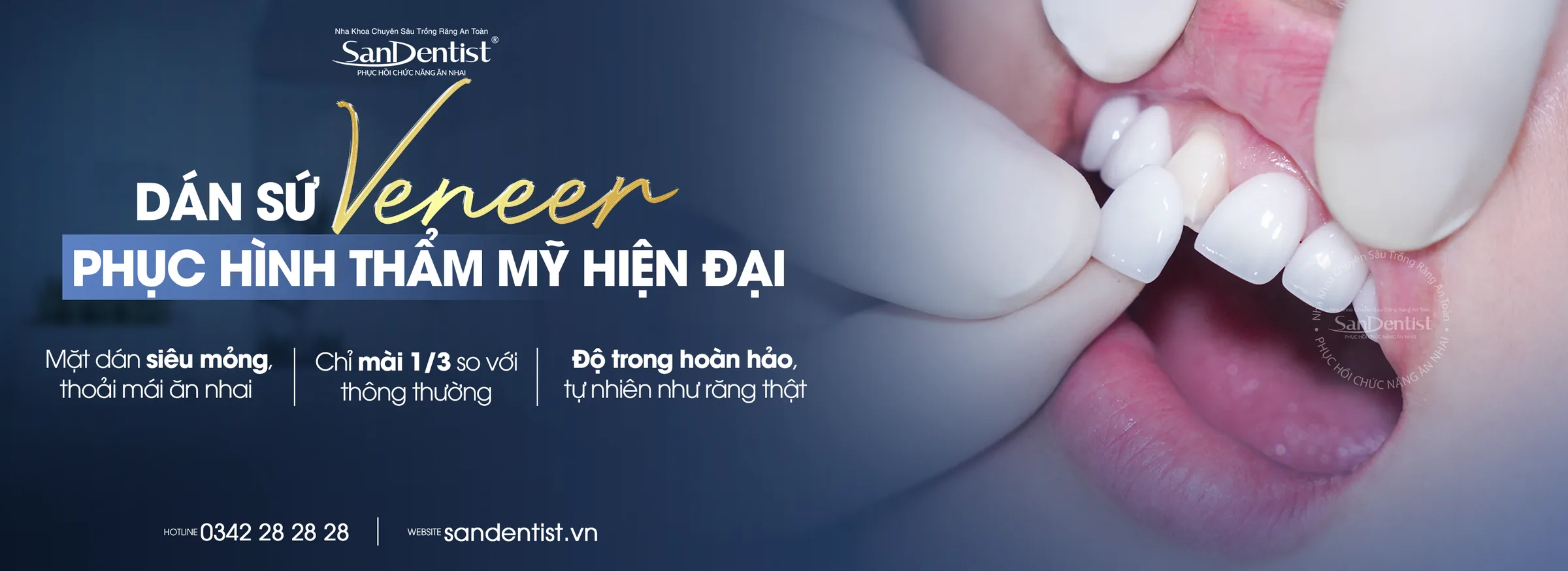 Dán sứ Veneer phục hình thẩm mỹ hiện đại tại San Dentist