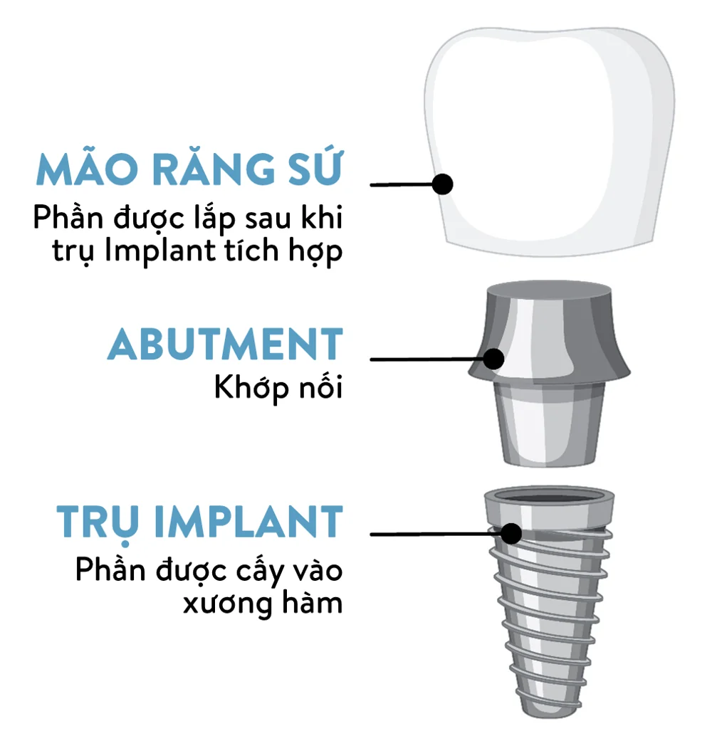 Dental implants consist of a porcelain crown, abutment, and implant post - cost breakdown at San Dentist