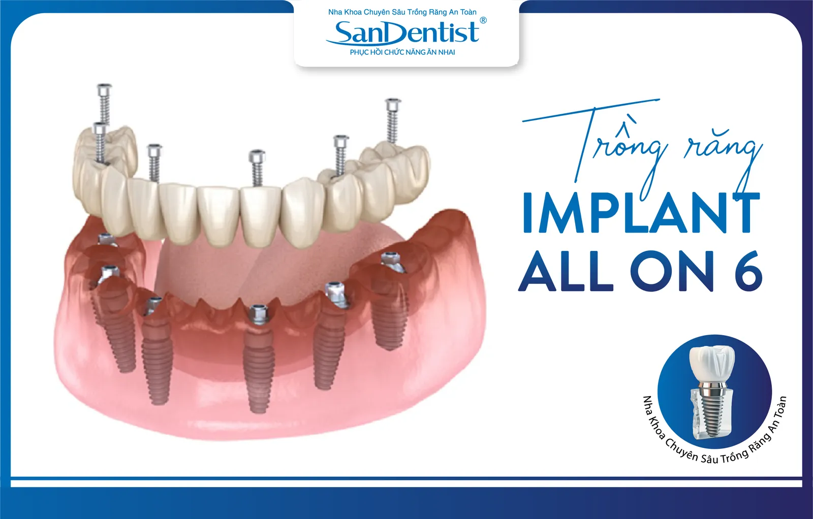 The All-On-6 full-arch implant method