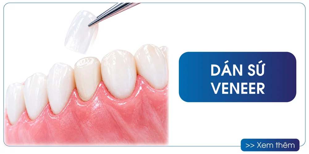 Dán sứ Veneer tại San Dentist