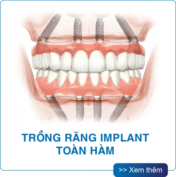 Trồng răng Implant toàn hàm tại San Dentist