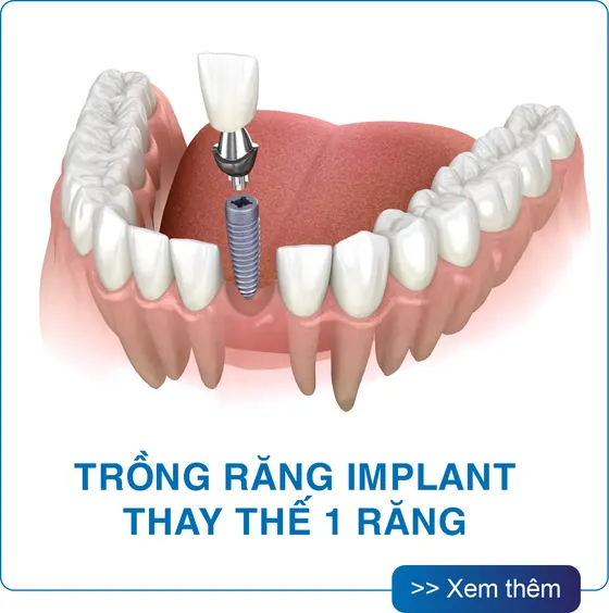 Trồng răng Implant thay thế 1 răng tại San Dentist