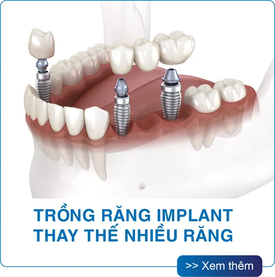 Trồng răng Implant thay thế nhiều răng tại San Dentist