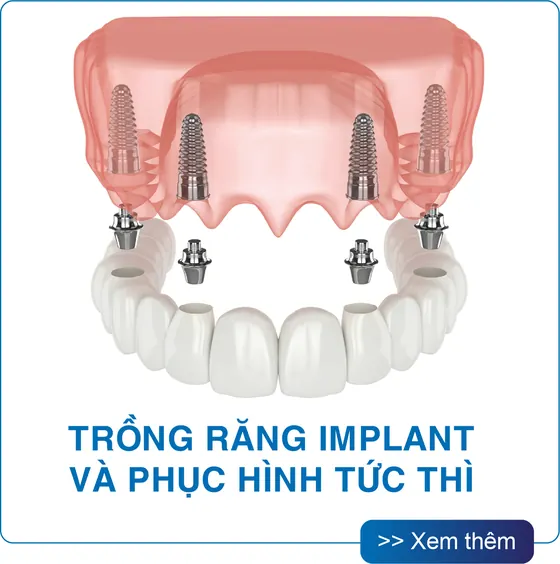 Trồng răng Implant và phục hình tức thì tại San Dentist