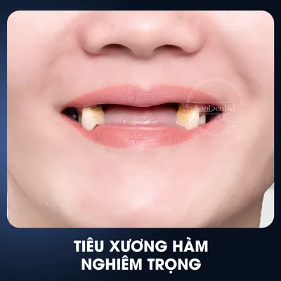 Tiêu xương hàm nghiêm trọng