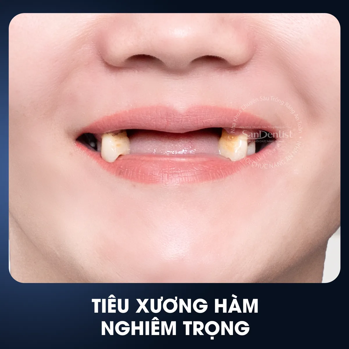 Tiêu xương hàm nghiêm trọng - hậu quả mất răng