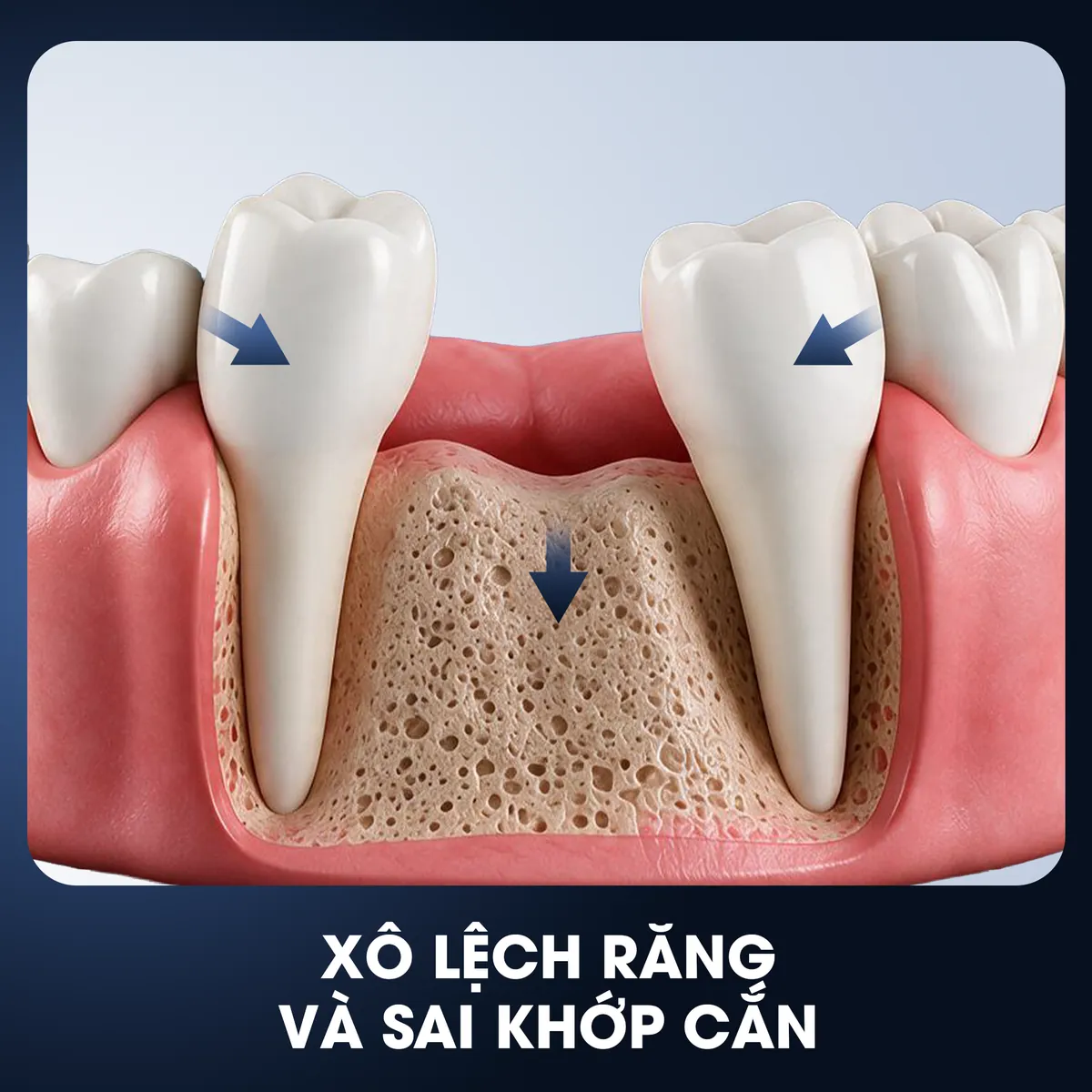 Xô lệch răng và sai khớp cắn - hậu quả mất răng