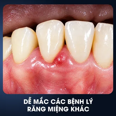 Dễ mắc bệnh lý răng miệng