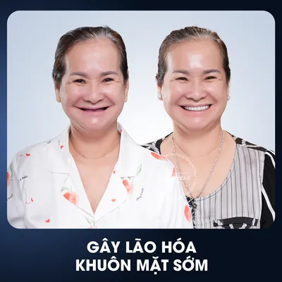 Lão hóa khuôn mặt sớm