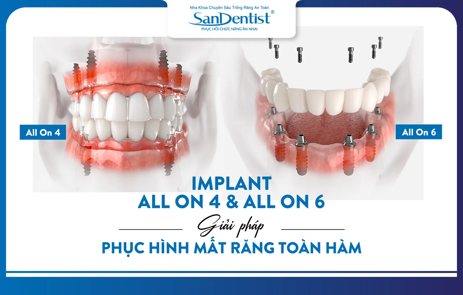 All-on-4 and All-on-6 implants - solutions for full-arch tooth restoration