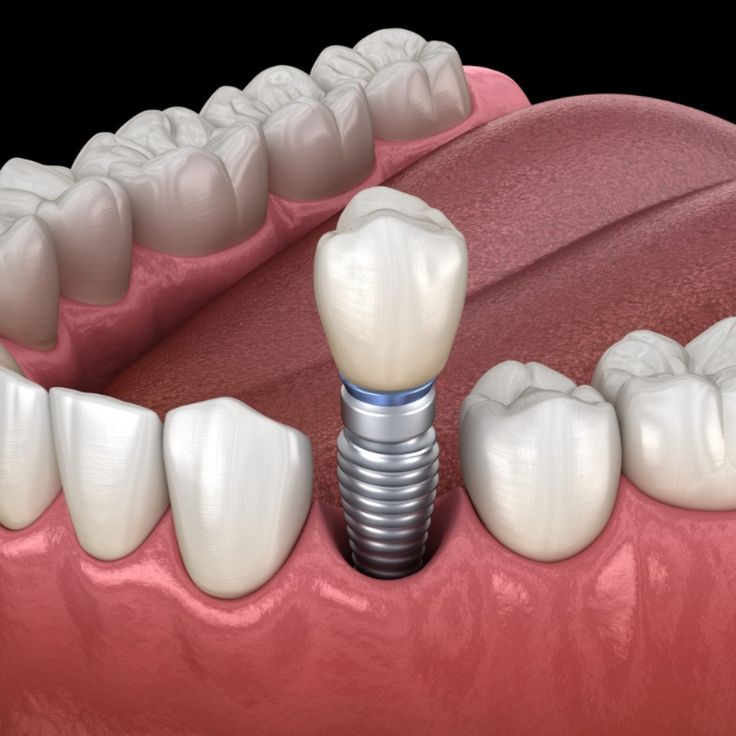 implant vs cầu răng sứ - hình 2