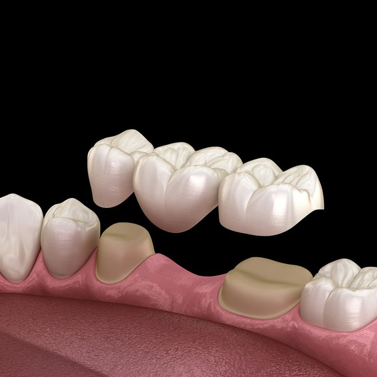 implant vs cầu răng sứ - hình 3