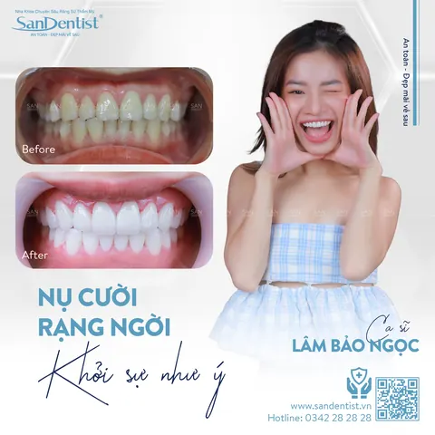 ca sĩ Lâm Bảo Ngọc - khách hàng San Dentist