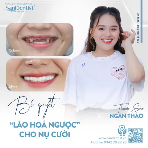 Thánh sún Ngân Thảo - khách hàng San Dentist