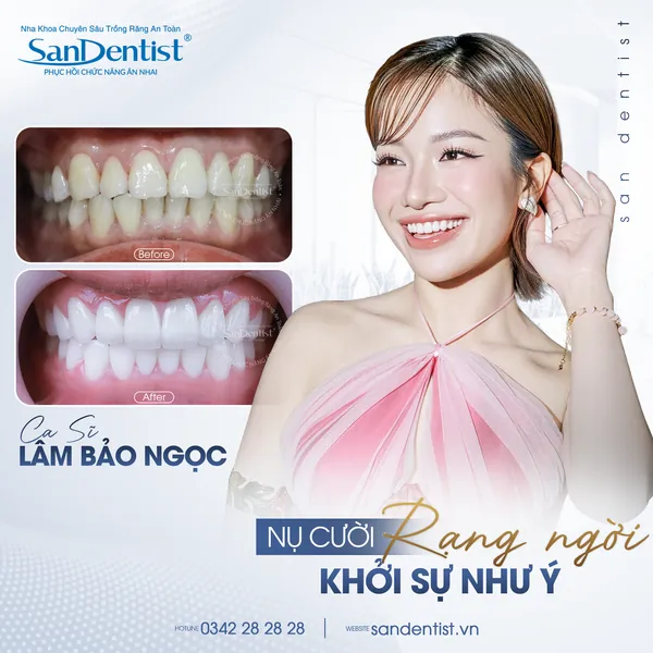 Ca sĩ Lâm Bảo Ngọc - nụ cười trước và sau tại San Dentist