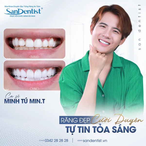 Ca sĩ Minh Tú Min.T - nụ cười trước và sau tại San Dentist