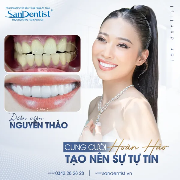 Diễn viên Nguyễn Thảo - nụ cười trước và sau tại San Dentist