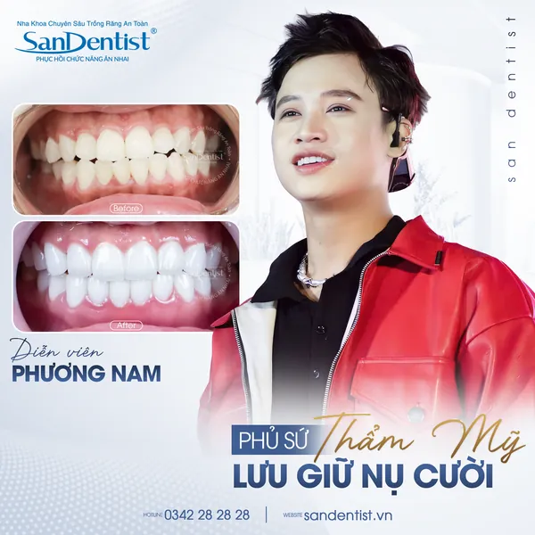 Diễn viên Phương Nam trước và sau phủ sứ thẩm mỹ tại San Dentist