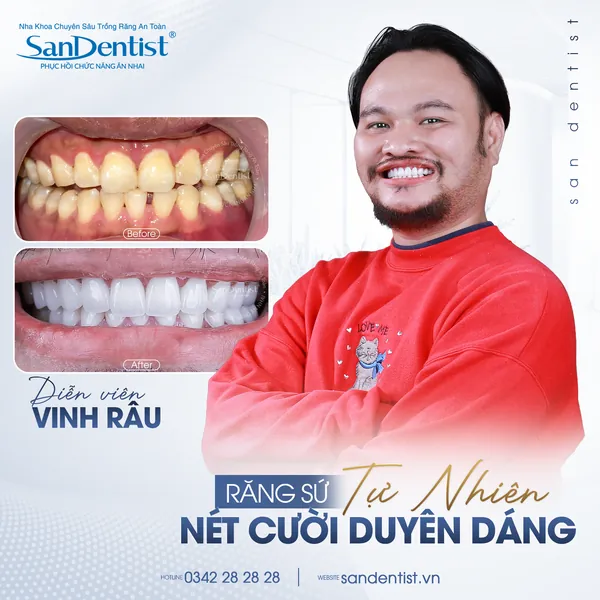 Diễn viên Vinh Râu trước và sau răng sứ tại San Dentist