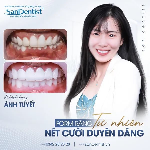 Khách hàng Ánh Tuyết - nụ cười trước và sau tại San Dentist
