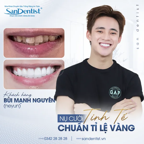 Khách hàng Bùi Mạnh Nguyên (Neyun) - nụ cười trước và sau tại San Dentist