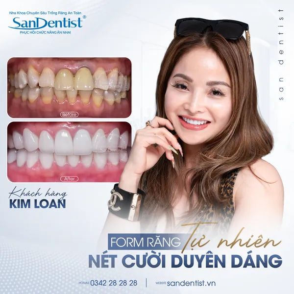 Khách hàng Kim Loan - nụ cười trước và sau tại San Dentist