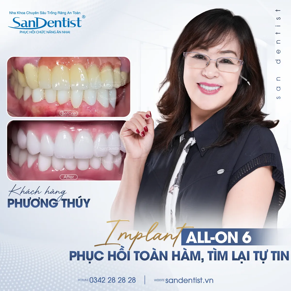 Khách hàng Phương Thúy trước và sau trồng răng Implant toàn hàm All-on-6 tại San Dentist