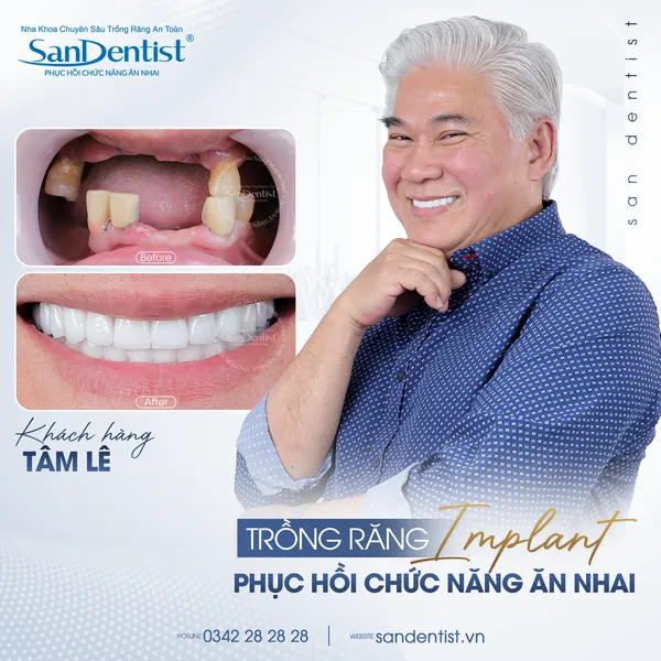 Khách hàng Tâm Lê trước và sau trồng răng Implant tại San Dentist