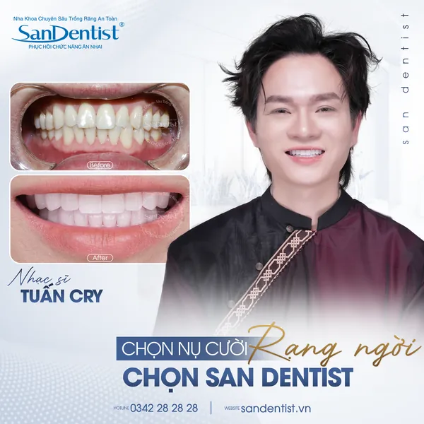 Nhạc sĩ Tuấn Cry - nụ cười trước và sau tại San Dentist