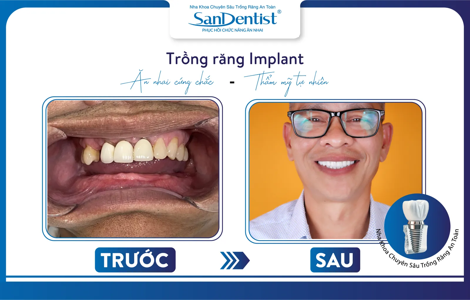 Patients can restore missing teeth with dental implants at San Dentist