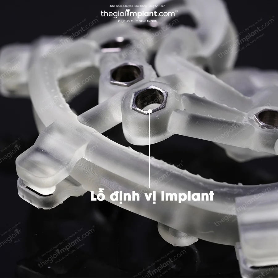 Máng định vị DSG cấy Implant không rạch nướu tại San Dentist