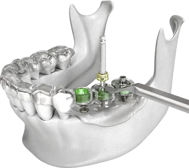 Máng định vị DSG in 3D giúp bác sĩ cấy trụ Implant theo đúng kế hoạch