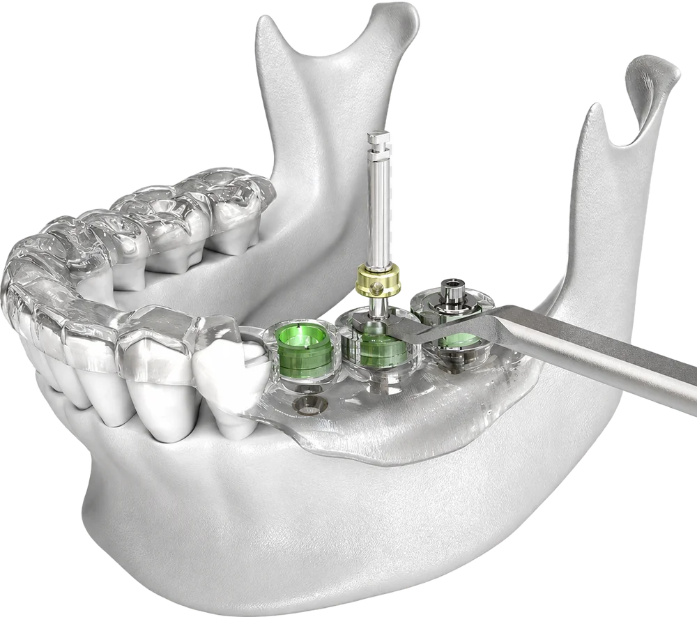 Máng định vị DSG cấy Implant không rạch nướu tại San Dentist