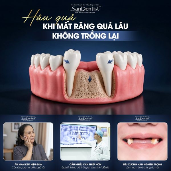 Mất răng có nên trồng Implant không? Giải đáp 2026