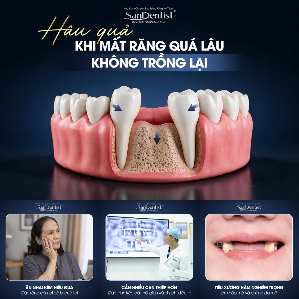 Mất răng có nên trồng Implant không? Giải đáp 2026