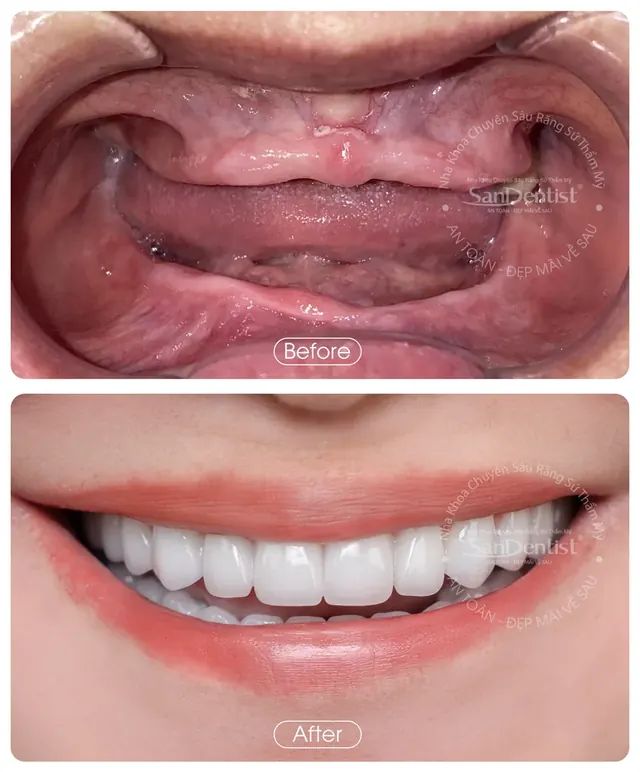 Nụ cười khách hàng trước và sau khi làm răng tại San Dentist - ca 1
