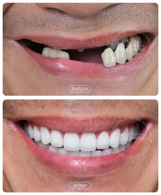 Nụ cười khách hàng trước và sau khi làm răng tại San Dentist - ca 2