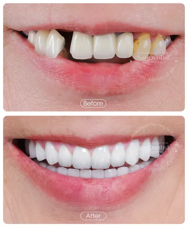 Nụ cười khách hàng trước và sau khi làm răng tại San Dentist - ca 3