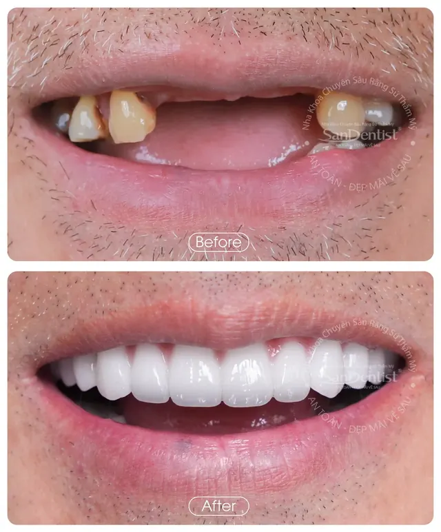Nụ cười khách hàng trước và sau khi làm răng tại San Dentist - ca 5