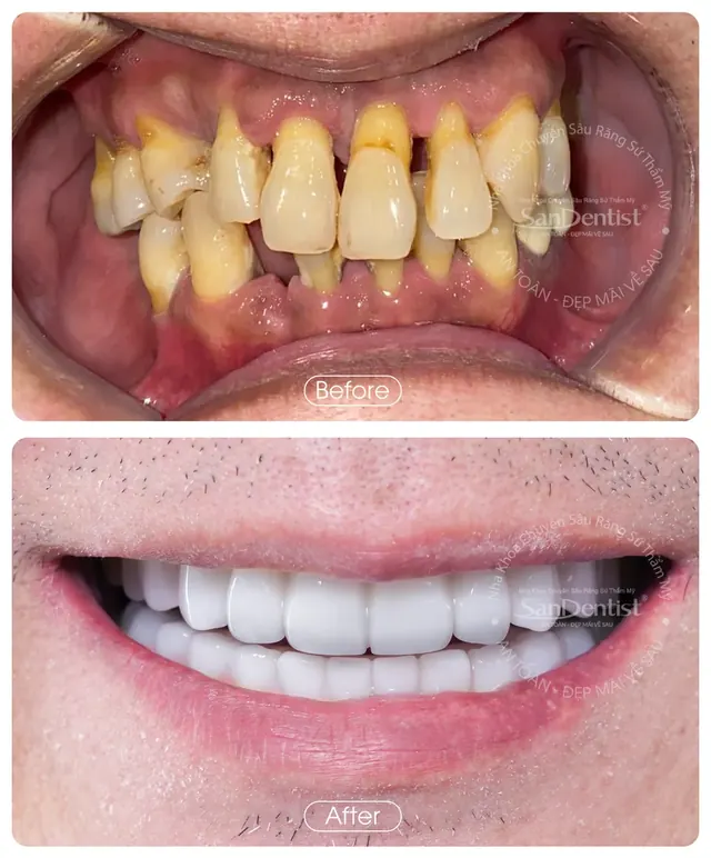 Nụ cười khách hàng trước và sau khi làm răng tại San Dentist - ca 8