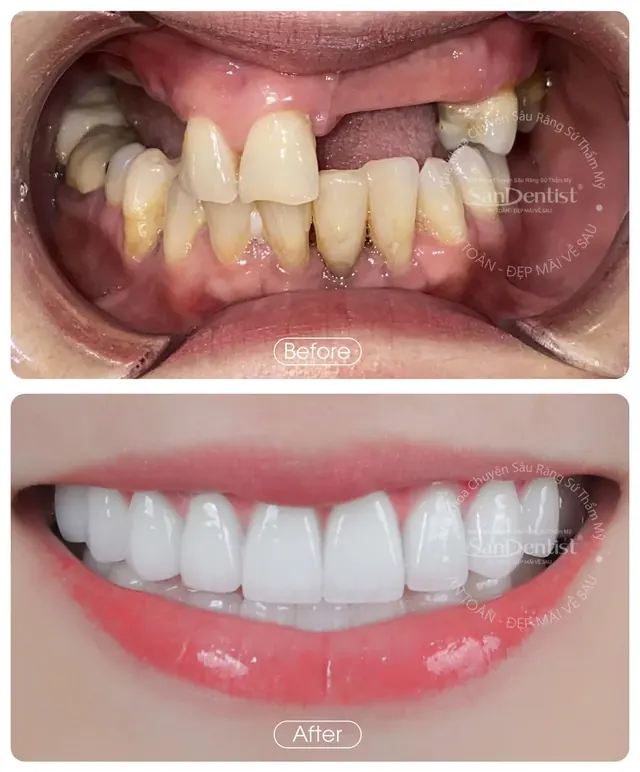 Nụ cười khách hàng trước và sau khi làm răng tại San Dentist - ca 9