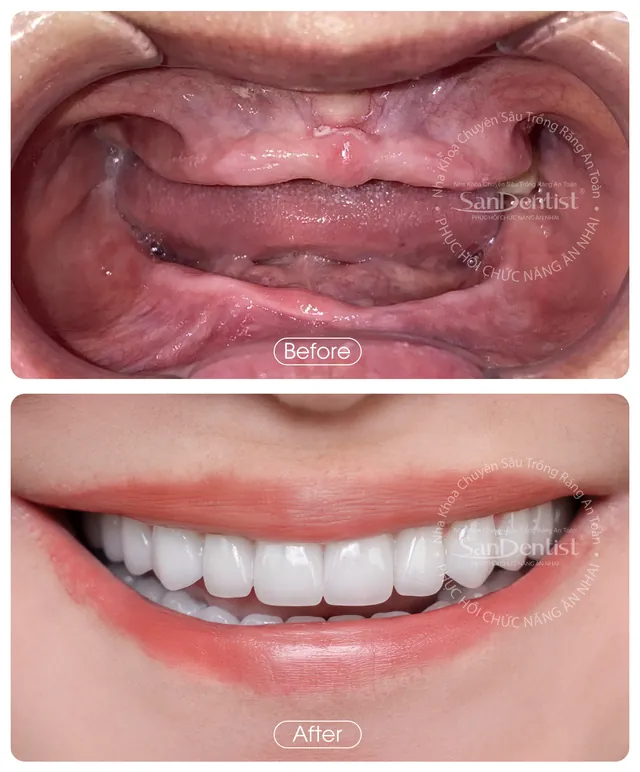 Nụ cười khách hàng trước và sau khi làm răng tại San Dentist - ca 1