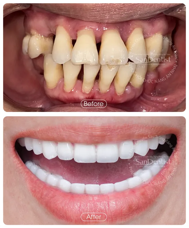 Nụ cười khách hàng trước và sau khi làm răng tại San Dentist - ca 4