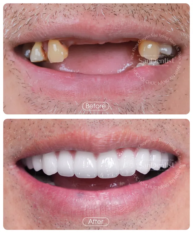 Nụ cười khách hàng trước và sau khi làm răng tại San Dentist - ca 5