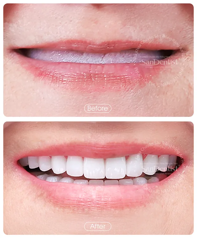 Nụ cười khách hàng trước và sau khi làm răng tại San Dentist - ca 6