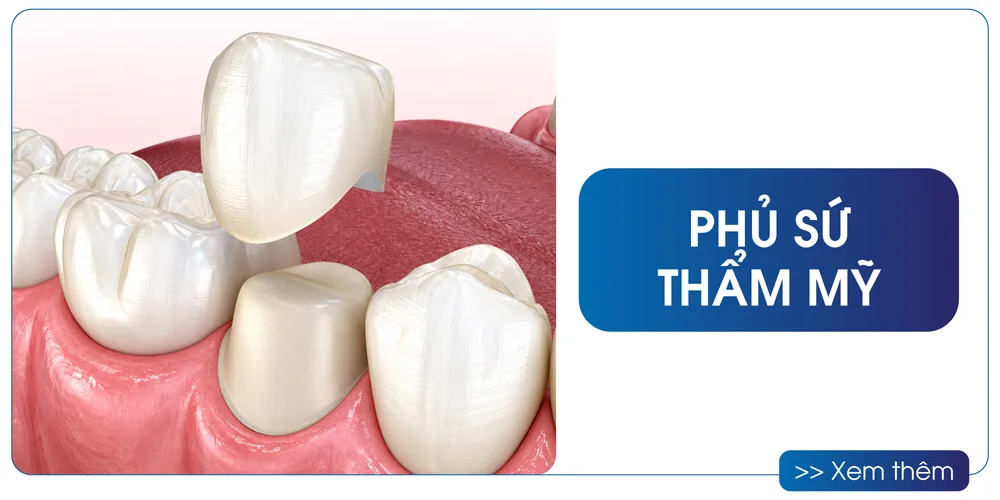 Phủ sứ thẩm mỹ tại San Dentist