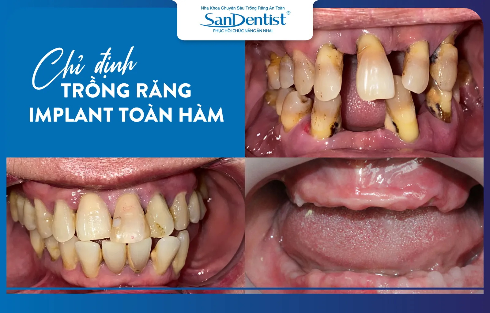 Cases where full-arch dental implant placement is indicated